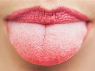 Triệu chứng cảnh báo ung thư lưỡi dễ nhầm lẫn với nhiệt miệng