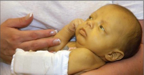 Bệnh vàng da ở trẻ sơ sinh: Biến chứng nguy hiểm, chớ coi thường