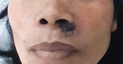 Nốt ruồi cảnh báo nguy cơ ung thư da