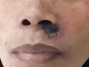 Nốt ruồi cảnh báo nguy cơ ung thư da
