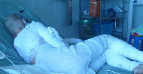 Nổi máu ghen, vợ tạt axit chồng để "dằn mặt" 