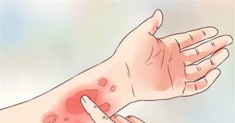 Nguyên nhân và cách khắc phục tình trạng da ngứa mùa lạnh