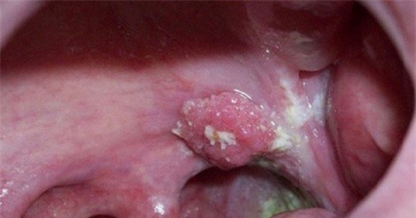 Cánh mày râu phải làm gì trước nguy cơ “virus phụ nữ” tấn công?