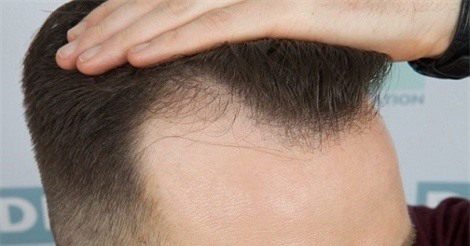 Bất ngờ với công dụng trị hói đầu từ khoai tây chiên