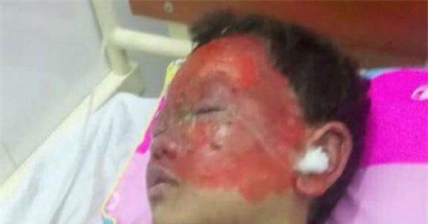 Hà Tĩnh: Học sinh lớp 2 bị bỏng nặng do nghịch pháo