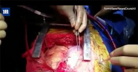 Kỳ lạ người đàn ông có 2 quả tim cùng đập