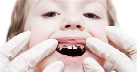 Mẹo chữa sún răng an toàn, hiệu quả cho bé mẹ nên biết