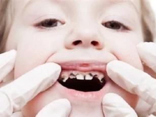 Mẹo chữa sún răng an toàn, hiệu quả cho bé mẹ nên biết