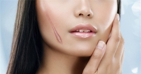 Những thực phẩm là "thủ phạm" gây sẹo lồi cần tránh xa