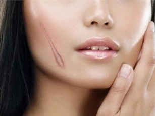 Những thực phẩm là "thủ phạm" gây sẹo lồi cần tránh xa