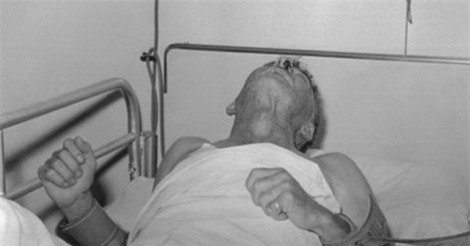 Bệnh dại và cách phòng tránh bệnh dại