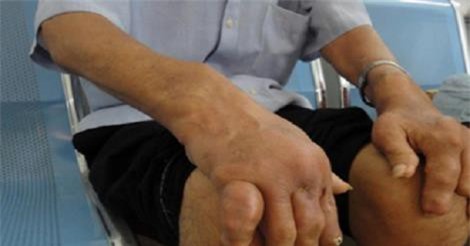 Giật mình với biến chứng nguy hiểm từ bệnh gout ít ai biết