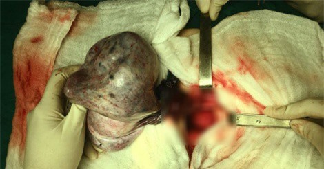 Bé gái bị hoại tử buồng trứng do khối u lạ ở bụng dưới