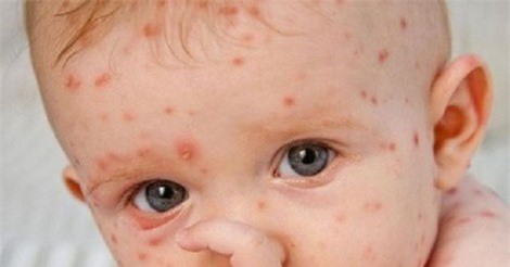 Giao mùa xuân - hè, trẻ dễ mắc bệnh, bố mẹ phải làm gì?