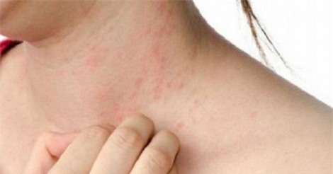 Làm thế nào để bảo vệ làn da trong thời tiết nóng, ẩm?