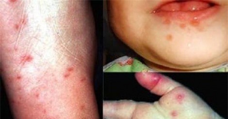 Mùa hè cẩn trọng với bệnh chân tay miệng