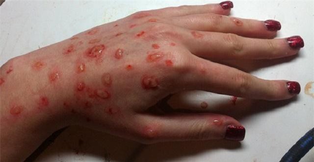 Những sai lầm "chết người" khiến bệnh thủy đậu ngày càng trầm trọng hơn