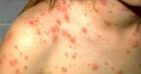 Phải làm gì khi bị thủy đậu?