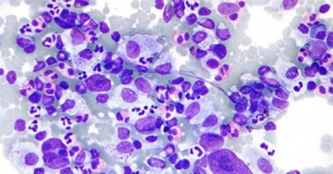 Thử nghiệm văcxin ung thư trên người