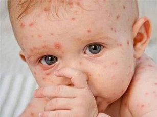 Những điều tuyệt đối kiêng kị với người bị thủy đậu không phải ai cũng biết