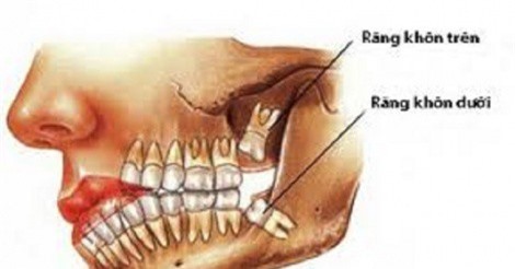 Những nguy hiểm khôn lường khi nhổ răng khôn