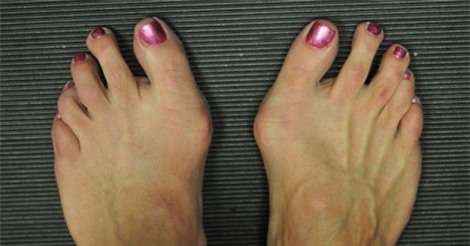 Vì sao không nên đi giày cao gót thường xuyên?