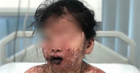 NÓNG: Bé gái 7 tuổi gặp nguy kịch vì dị ứng thuốc