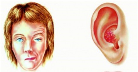 Cảnh giác với biến chứng zona hạch gối sau khi mắc bệnh thủy đậu