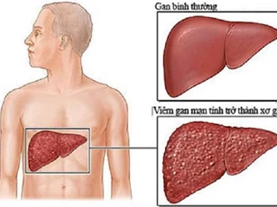 Viêm gan B nguy hiểm như thế nào?