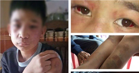 Bé trai bị bố và mẹ kế đánh bầm tím khắp người
