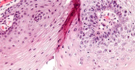 Bệnh sùi mào gà ở nam và nữ khác nhau thế nào?