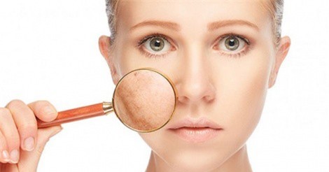 Cách trị nám da từ nguyên liệu tự nhiên dễ tìm