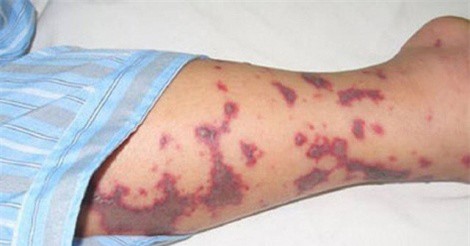 Viêm não mô cầu có thể giết chết người khỏe mạnh trong 24 giờ