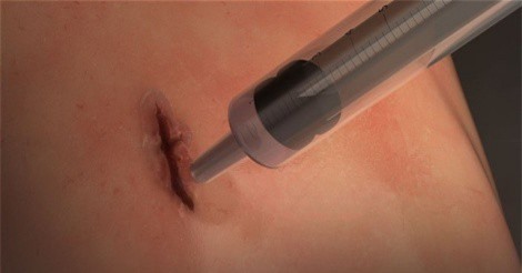 Tương lai sẽ có keo chữa lành vết thương trong 60 giây