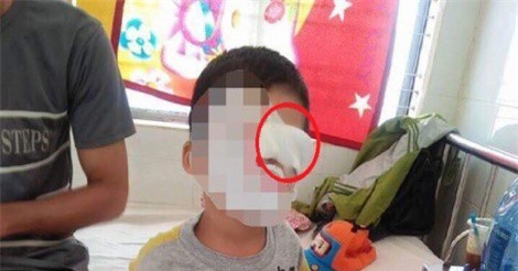 Phụ huynh yêu cầu xử lý giáo viên để bé trai bị bạn bắn bút chì trúng mắt