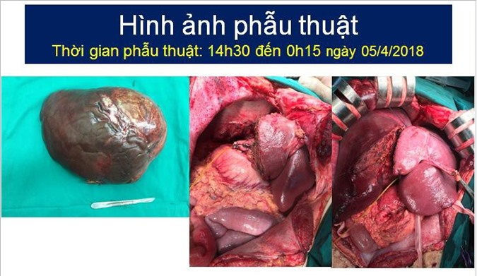 Cắt bỏ khối u gan 5kg ở bệnh nhân có bệnh lý hiếm gặp trên thế giới