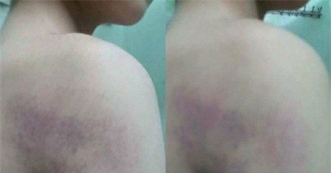 Kỷ luật cô giáo đánh học sinh lớp 1 bầm tím khắp người