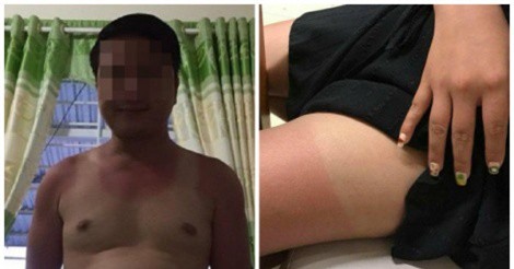 Góc tắm biển mùa hè: Bao năm dưỡng trắng, cháy nắng một giờ