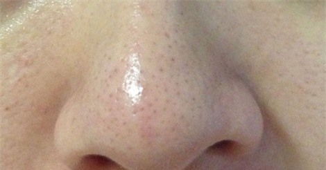 2 công thức mặt nạ giúp loại bỏ mụn đầu đen hiệu quả