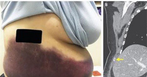 Người phụ nữ ho đến gãy cả xương sườn