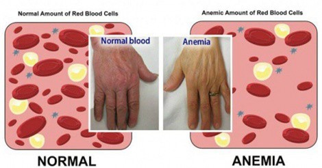 Thiếu máu và những lưu ý về dinh dưỡng