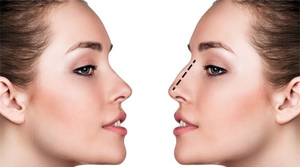 Những điều cần biết về phẫu thuật thẩm mỹ mũi