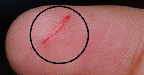 Vết trầy xước, đứt tay rất lâu lành, có phải do da "dữ": Vấn đề nghiêm trọng hơn bạn nghĩ