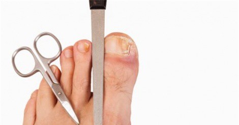 Những cách tự nhiên chữa móng chân mọc lệch đâm vào da thịt