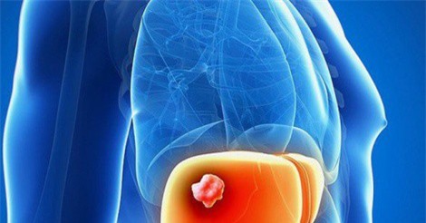 Nguyên nhân gây ung thư gan ít người biết