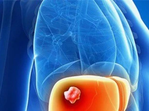 Nguyên nhân gây ung thư gan ít người biết