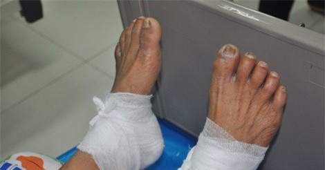 Bệnh nhân đái tháo đường bị bỏng độ 3 do chườm bằng lá thuốc