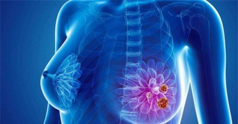 Dấu hiệu cảnh báo ung thư vú ở nam và nữ