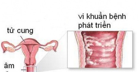 Hầu hết phụ nữ mắc bệnh nhiễm khuẩn âm đạo