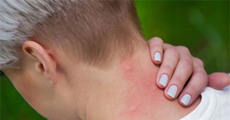 Vì sao một vài người lại bị muỗi đốt nhiều hơn người khác?